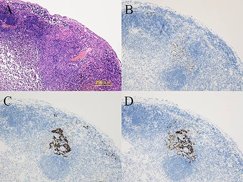 Histological findings showing the metastatic tumor in the mediastinal lymph nodes (A). Immunohistochemistry demonstrating positive staining for TTF-1 (B), AE1/AE3 (C), and EMA (D) in the metastatic tumor cells.