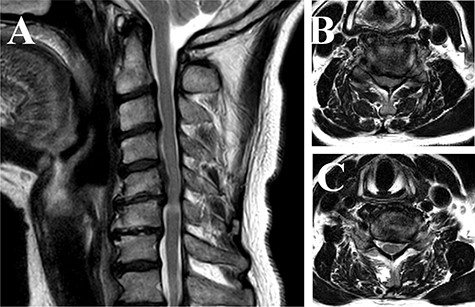 Magnetic resonance imaging of the cervical spine (T2-weighted image). (A) Sagittal view images showed that compressive lesions in the cervical spine were located at the C5-C6 levels. The high signal lesion in the spinal cord was seen at the C5-C6 level. (B) Axial view of the C5-C6 level showed the spinal cord compression in the canal. (C) Axial view of the C6-C7 level showed the stenosis of the left side of foramen.
