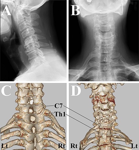 Cervical spine X-ray and computed tomography (CT) images. (A) X-rays image of lateral view showed the straight alignment of the cervical spine. (B) X-rays image of anterior–posterior view showed bilateral sloping shoulders. (C) CT image of posterior–anterior view. The first rib on the right side originated from the higher position of the Th1 vertebra than that on the left side. (D) CT image of anterior–posterior view. CT revealed the existence of the joint between the first rib and the second rib on the right side.