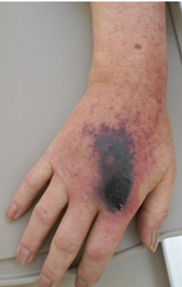 Macro-image of the right hand. The gangrene and inflammation developed 3 weeks after the onset of the paralysis in the right hand.