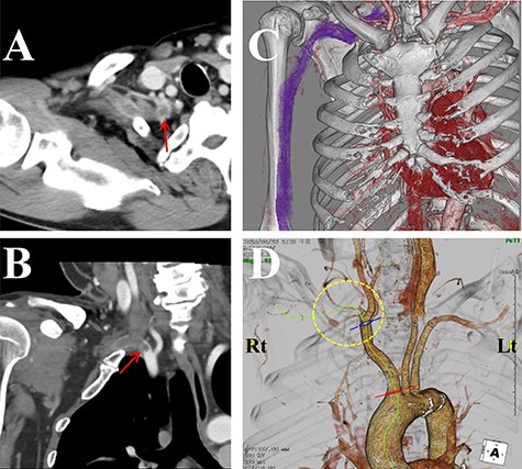 Contrast-enhanced computed tomography (CT) images of the thorax. (A) Axial view. (B) Coronal view. (C, D) Three-dimensional CT images. The subclavian artery (circle) was occluded due to a thrombus (arrow) at the level of the dysplasia of ribs.
