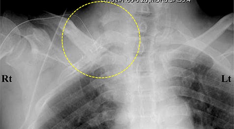 Postoperative cervicothoracic spine X-ray. Anterior–posterior view. The right first and second ribs were surgically resected (circle).