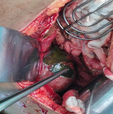Intraoperative view of perforation at the fundus of gallbladder.
