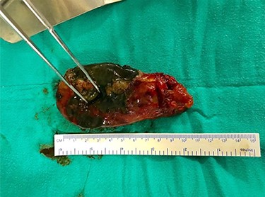Gross specimen of gallbladder showing perforation in fundus region.