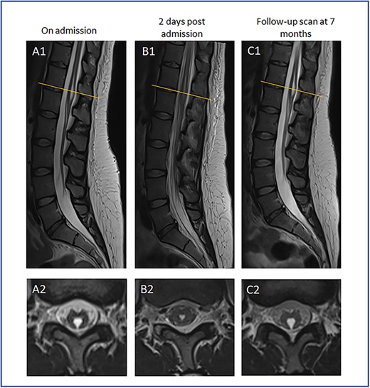 MR spinal imaging during admission and at follow-up. T2 weighted MR sagittal (A1-C1) and axial (A2-C2) images at T12/L1 level (orange line). A—Admission MRI, B—MRI 2 days post admission, C—7 month follow-up scan. A1 + 2 at initial presentation with expanded TV cyst compressing conus causing acute neurological deficit. B1 + 2 showing conus appearances post TV cyst rupture corresponding with resolution of neurological symptoms. C1 + 2 images at 7 month follow-up in keeping with cyst recollection with no corresponding neurological deficit.