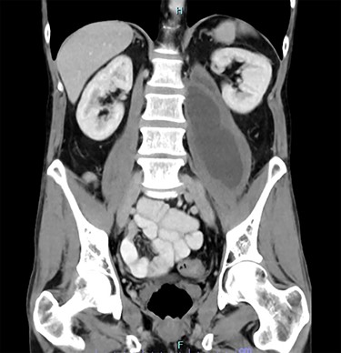 CT showing pseudocyst extending into left psoas muscle.