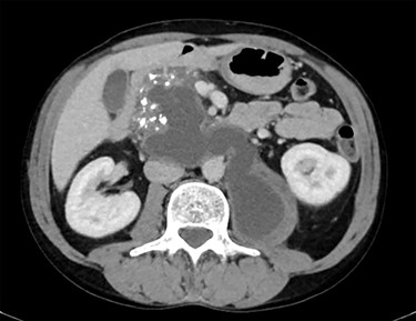 CT showing calcified pancreas with pseudocyst extending from pancreas to left psoas muscle.
