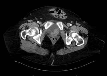 An axial image of the bladder tumour.