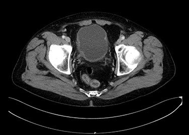 An axial image of the bladder tumour.