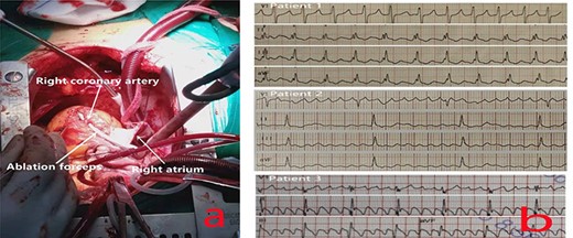 (a) Ablation at the midpoint of the annulus of the anterior leaflet of the tricuspid valve; to avoid injuring the right coronary artery during the operation, the right coronary artery was freed, and ablation forceps were placed under it during ablation to ensure that the ablation line extended to the tricuspid annulus and was completely transmural. (b) The preoperative ECG of all patients showed typical AFL.