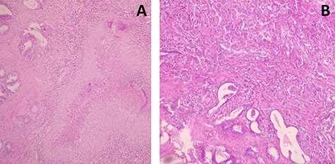 (A) Prostatic parenchyma seat granuloma epithelioid and giant cell centered by a caseous necrosis (haematoxylin and eosin ×40). (B) Carcinomatous proliferations organized in glandular structures realizing cribriform and polyadenoid clusters (haematoxylin and eosin ×100).