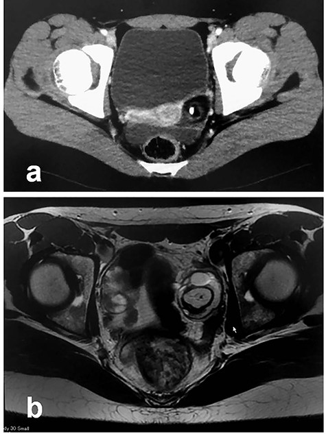Radiologic findings in Patient 1; (a): Enhanced CT; (b): MRI.