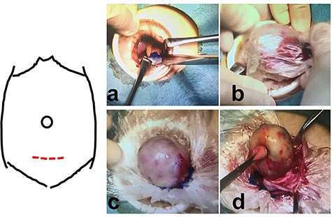 Intraoperative findings in Patient 1; (a–c): A suprapubic incision, with wound retractor, is used for removal of the specimen that was previously placed in a specimen retrieval bag; (d): Ovarian cystectomy is performed inside the specimen retrieval bag without content spillage.