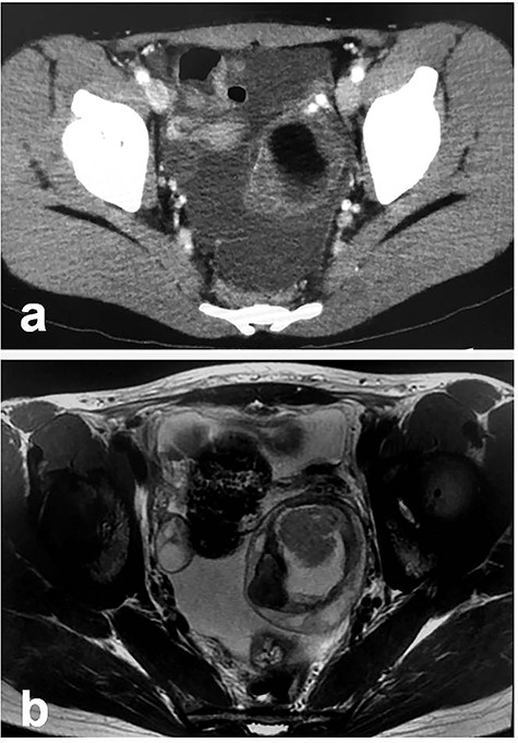 Radiologic findings in Patient 2; (a): Enhanced CT; (b): MRI.