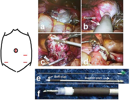 Intraoperative findings in Patient 2; (a): The tumor is laparoscopically placed in a specimen retrieval bag; (b): A soft-cup aspirator set is attached to the surface of a tumor, and the contents are aspirated; (c): Ovarian cystectomy is performed laparoscopically, within the specimen retrieval bag, without content spillage; (d): The excised margins are continuously oversewn using an absorbable wound closure device; (e): The soft-cup aspirator set (upper, suction needle; lower, soft-cup aspirator); (f): Before attaching the soft-cup aspirator to a tumor, the suction needle is placed within the soft-cup aspirator, with the tip of the needle protected.