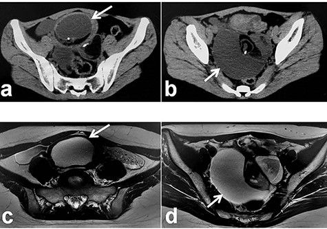 Radiologic findings in Patient 3; (a): Plain CT showing the left-sided tumor (white arrow); (b): Plain CT showing the right-sided tumor (white arrow); (c): MRI showing the left-sided tumor (white arrow); (d): MRI showing the right-sided tumor (white arrow).