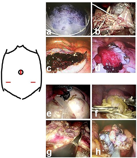 Intraoperative findings in Patient 3; (a–d): Left-sided tumor (e–h): Right-sided tumor After laparoscopically releasing torsion of the left ovarian tumor, each tumor is placed into a specimen retrieval bag and excised. When content spillage is recognized, peritoneal lavage is performed using large amounts of warmed fluid. The excised margins are continuously sutured using an absorbable wound closure device.