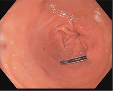 EGD on initial presentation; gastric antrum with foreign body perforating through the gastric wall.