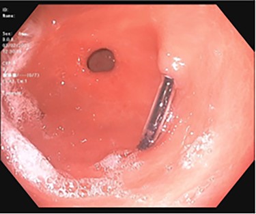Subsequent EGD 3 days later; gastric antrum with foreign body perforating through the gastric wall; normal gastric mucosa after ingestion of bleach.