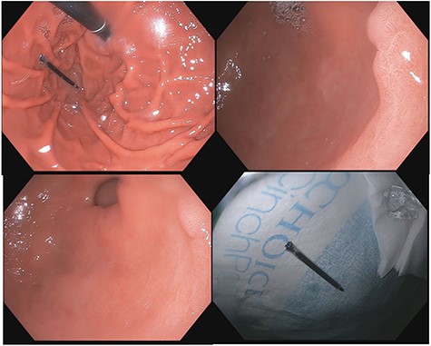 (a–d) Subsequent EGD 1 week later; (a) foreign body in the fundus of the stomach; (b and c) irregularity in the antrum corresponding to site of previous perforation; (d) ink pen after transoral endoscopic removal.