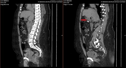 Side-by-side comparison of foreign body perforating through stomach (right) and sealed site of perforation after endoscopic removal (left).