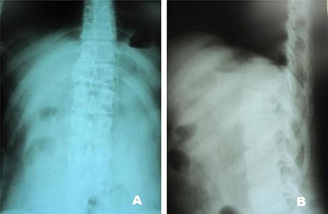 Case 1, (A): Anterior–posterior; (B): Lateral pre-operative X-ray.
