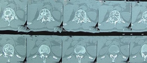 Case 1, Axial CT scan of twelfth thoracic spine vertebrae.
