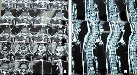 Case 1, (A): Axial T2-weighted MR image of twelfth thoracic spine vertebrae; (B): Sagittal T2-weightedimages of thoracic spine vertebrae.