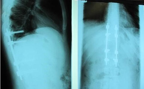 Case 1, Post-operative X-ray.