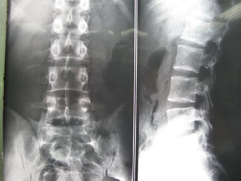 Case 2, Pre-operative X-ray.