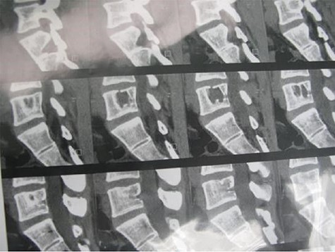 Case 2, CT- scan of L5 vertebrae.