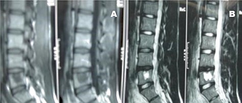Case 2, Sagittal T2-weighted and T1-weighted MR images of lumbar vertebrae show the body and homogeneous cystic lesion of L5.