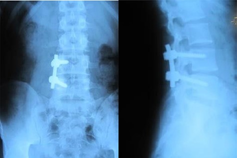 Case 2, Post-operative X-ray.