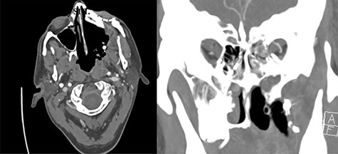Evidence of partially extruded embolization material within the left infratemporal fossa along the left maxillectomy defect in axial (left) and coronal (right) sections. Coronal view also demonstrates more inferior contrast blush concerning for pseudoaneurysm.