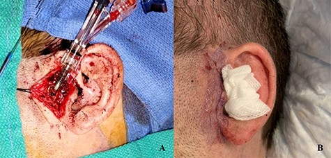 Cannulation of the STA through preauricular incision (A). Multilayered closure with superficial glue following decannulation (B).