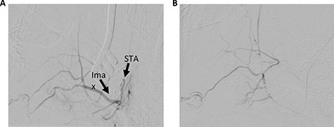 Left STA injection. (A) Pre-embolization and (B) post-embolization. Ima, internal maxillary artery.