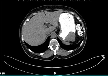 Axial view of the abdominopelvic CT scan with oral contrast showing a well-circumscribed gastric soft tissue attenuation. P: Posterior.