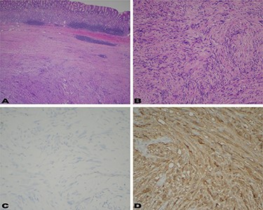 (A) Low power view shows a well-circumscribed submucosal mass composed of spindle cells with variable cellularity ranging from hypocellular to moderately cellular; (B) higher magnification at 10× shows spindle cells with tapered ends and no significant cytologic atypia; occasional areas show nuclear palisades; (C) CD117 and DOG-1 immunohistochemical stains are negative in the surgical specimen; (D) immunohistochemical stain for S-100 shows strong diffuse cytoplasmic staining.