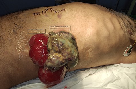 Oedematous and prolapse colostomy with necrosis of the greater omental eviscerating through the colostomy site.