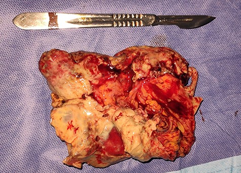 Surgical specimen showing the resected necrotic segment of the greater omentum.