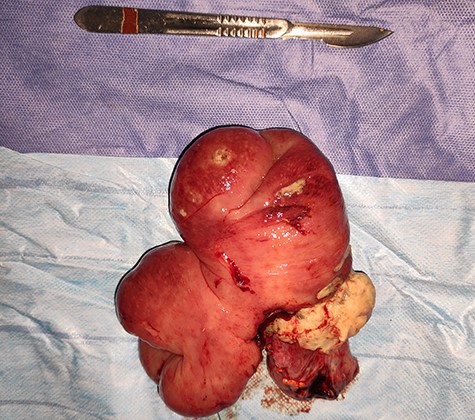 Surgical specimen of the resected prolapsed and oedematous colostomy.