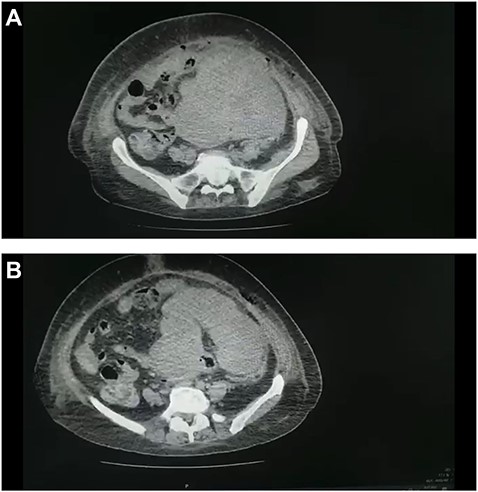 (A and B) CT scan of the abdomen and pelvis demonstrated a large pelvic mass adherent to the sigmoid colon and compressing its surrounding structures.
