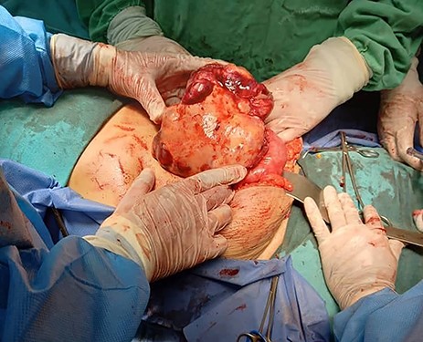 Tumour arising from the sigmoid colon, adherent to the small bowel and measured 12 × 13 × 16 cm.