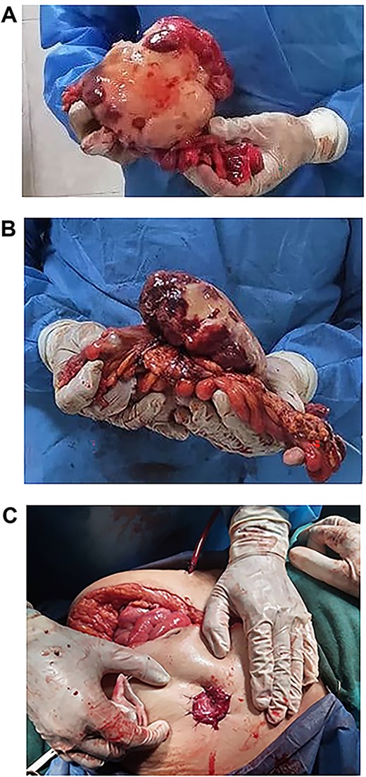(A, B and C) Tumour completely excised along with the sigmoid colon and its mesentery, and an end colostomy was created.
