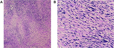 (A and B) Histopathology revealed a spindle cell neoplasm consistent with low-grade spindle cell sarcoma. There is no angioinvasion; border lines of resection are free of tumour.