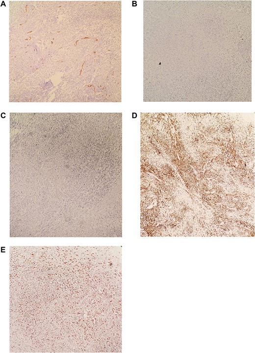 (A) IHC revealed CD34 negative. (B) IHC revealed CD117 negative. (C) IHC revealed S100 negative. (D) IHC revealed DESMIN positive. (E) IHC revealed KI-67 >30%. Diagnosis is consistent with moderately differentiated Leiomyosarcoma.