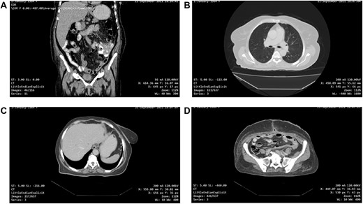 (A, B, C and D) One-month post-operative CT scan of the chest/abdomen/pelvis revealing a coronal view of the abdomen and pelvis/lung/liver/surgical site/pelvis free of tumour spread/metastasis/relapse.