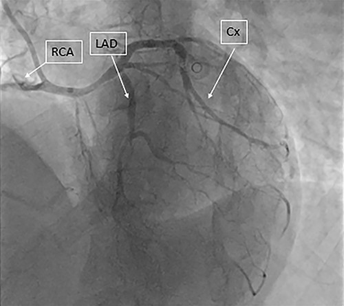 Coronary angiography showing the three coronary arteries arising from single ostium with short LAD and occluded RCA and circumflex artery is shown.