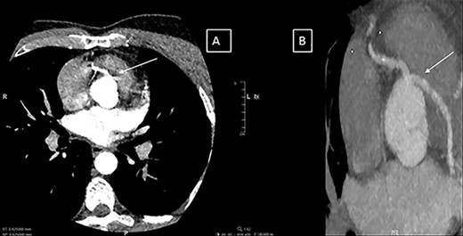 (A and B) Computerized tomography images showing the single coronary artery ostium and pathway of the abnormal vessel.