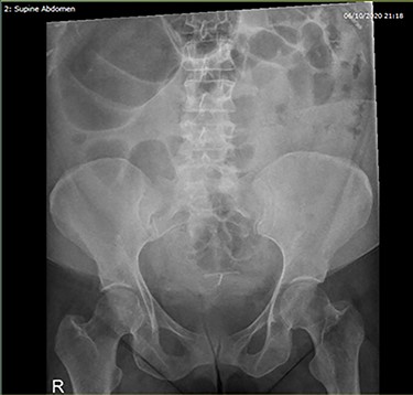 Abdominal X-Ray—right upper quadrant distended colonic loop.